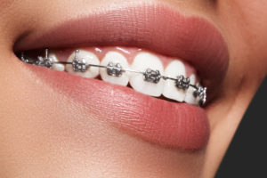 braces fitted 